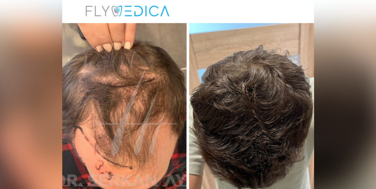 Zakola — Przyczyny, skutki i metody radzenia sobie z problemem